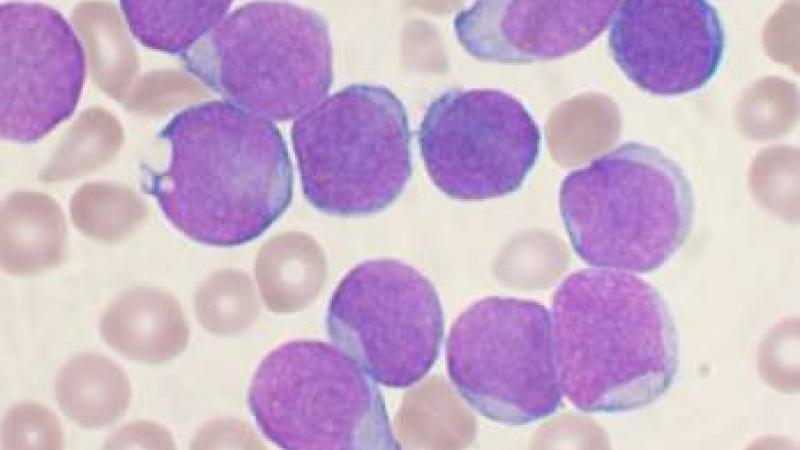 Leucemia