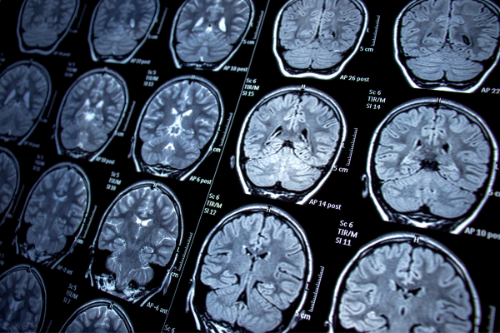 cerebro