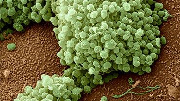 gonorrea
