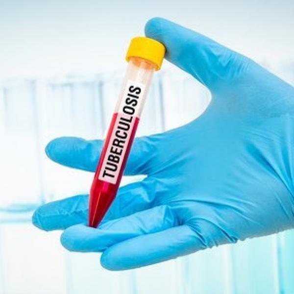 Tuberculosis