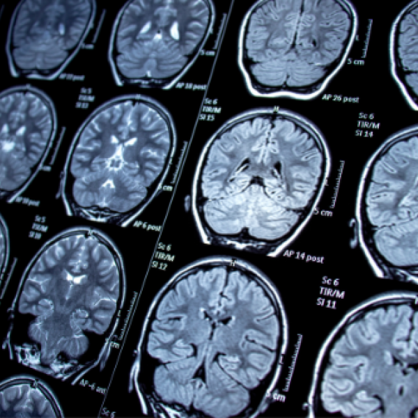 cerebro