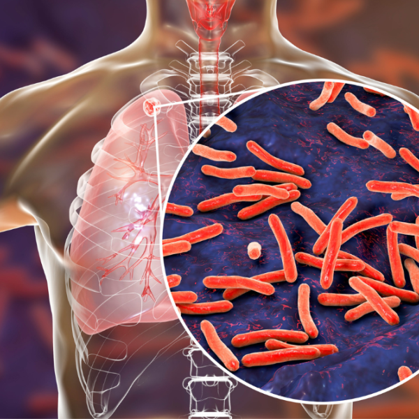 tuberculosis